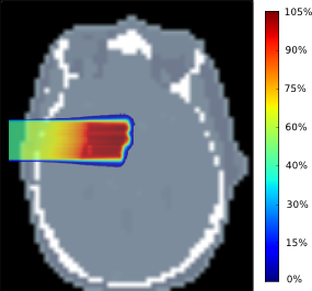 Monte Carlo based proton beam plan.